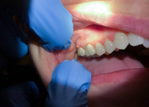 Best Emergency Dentist for Knocked-Out Tooth in Steele, MO