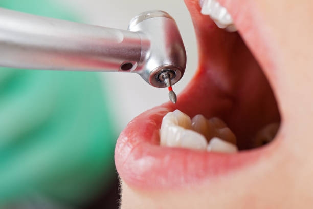 Best Emergency Dentist for Lost Fillings or Crowns in Steele, MO